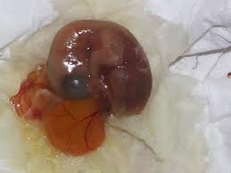 كيف شكل كيس الحمل إذا نزل